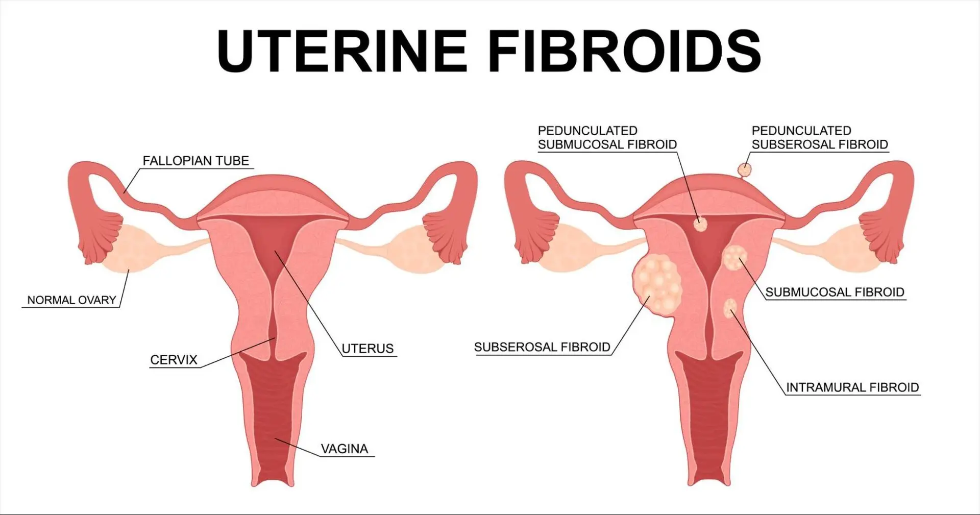 types of uterine fibroids